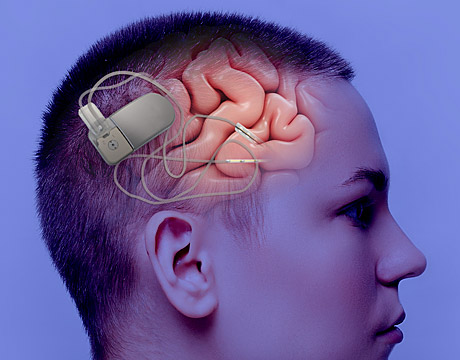 Profile of a person&rsquo;s head showing the brain, with a small sensing device and leads placed over it